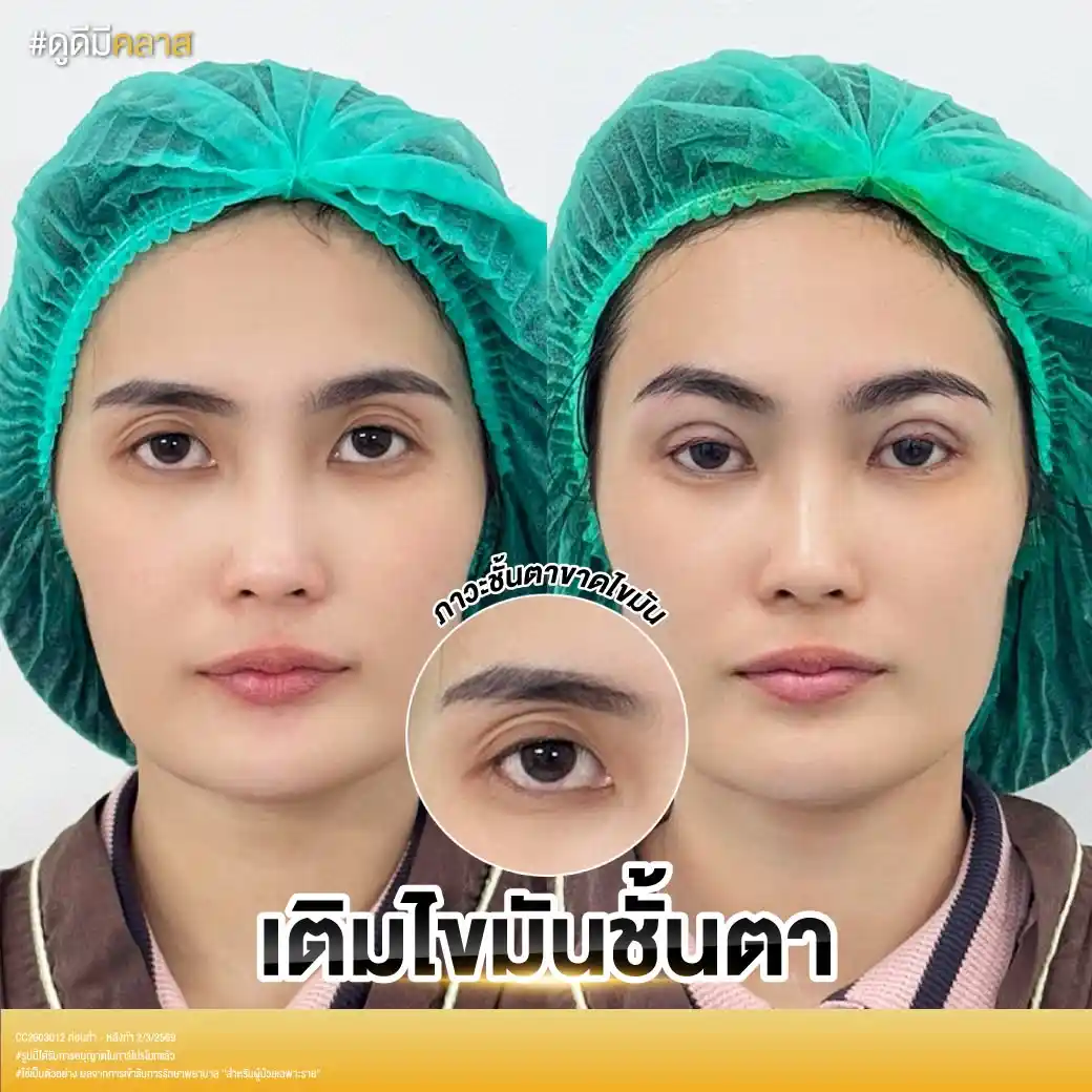 เติมไขมันตา สามารถเติมบริเวณไหนรอบดวงตาได้บ้าง