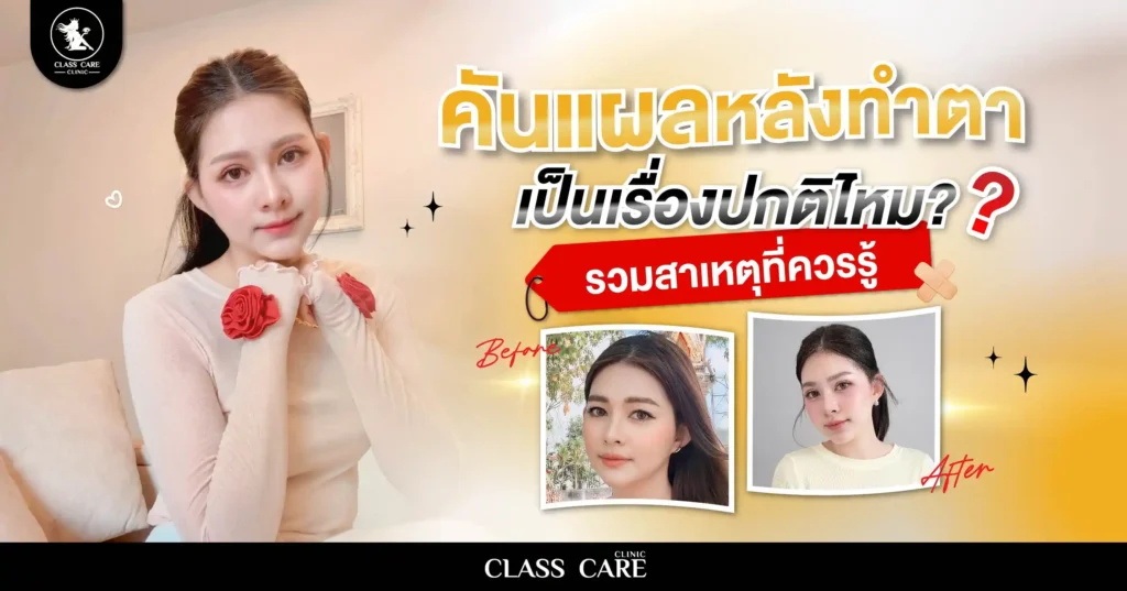 คันแผลหลังทำตา เป็นเรื่องปกติไหม? รวมสาเหตุที่ควรรู้