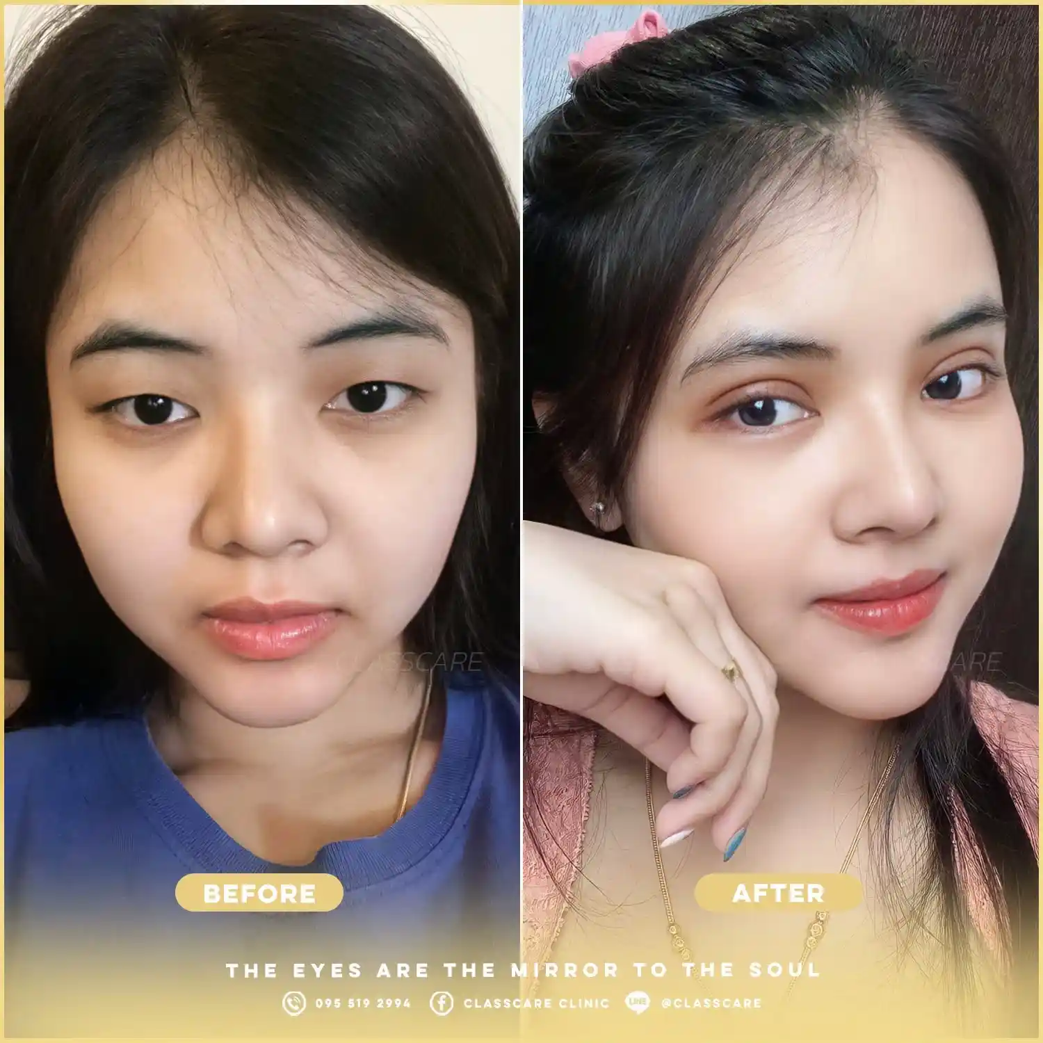 วิธีดูแลปัญหาตาชั้นเดียว ตาตี่