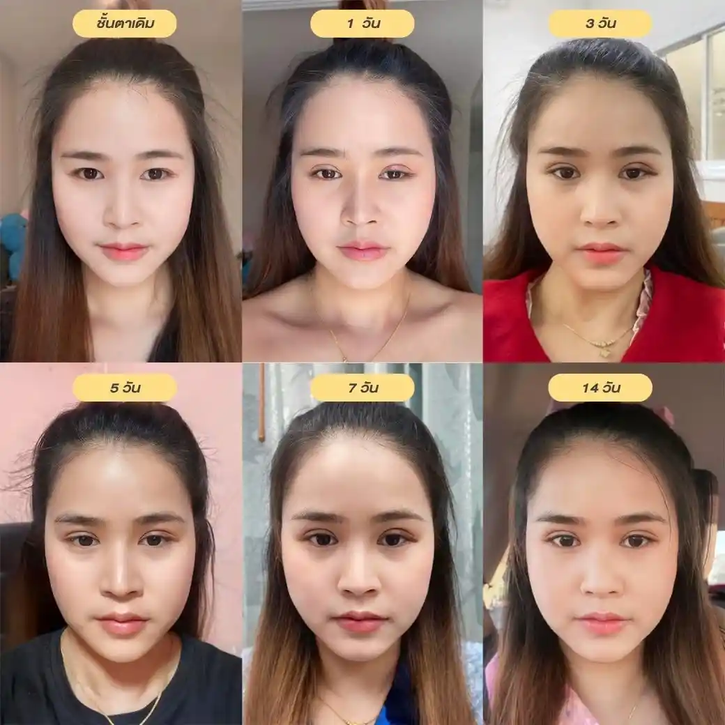 อาการคันหลังทำตา เกิดขึ้นช่วงไหนของการพักฟื้น