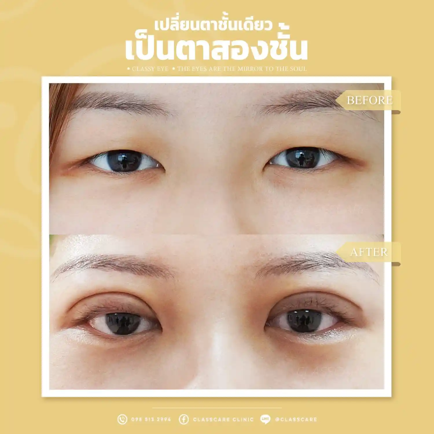 ตาชั้นเดียว ตาตี่ คืออะไร