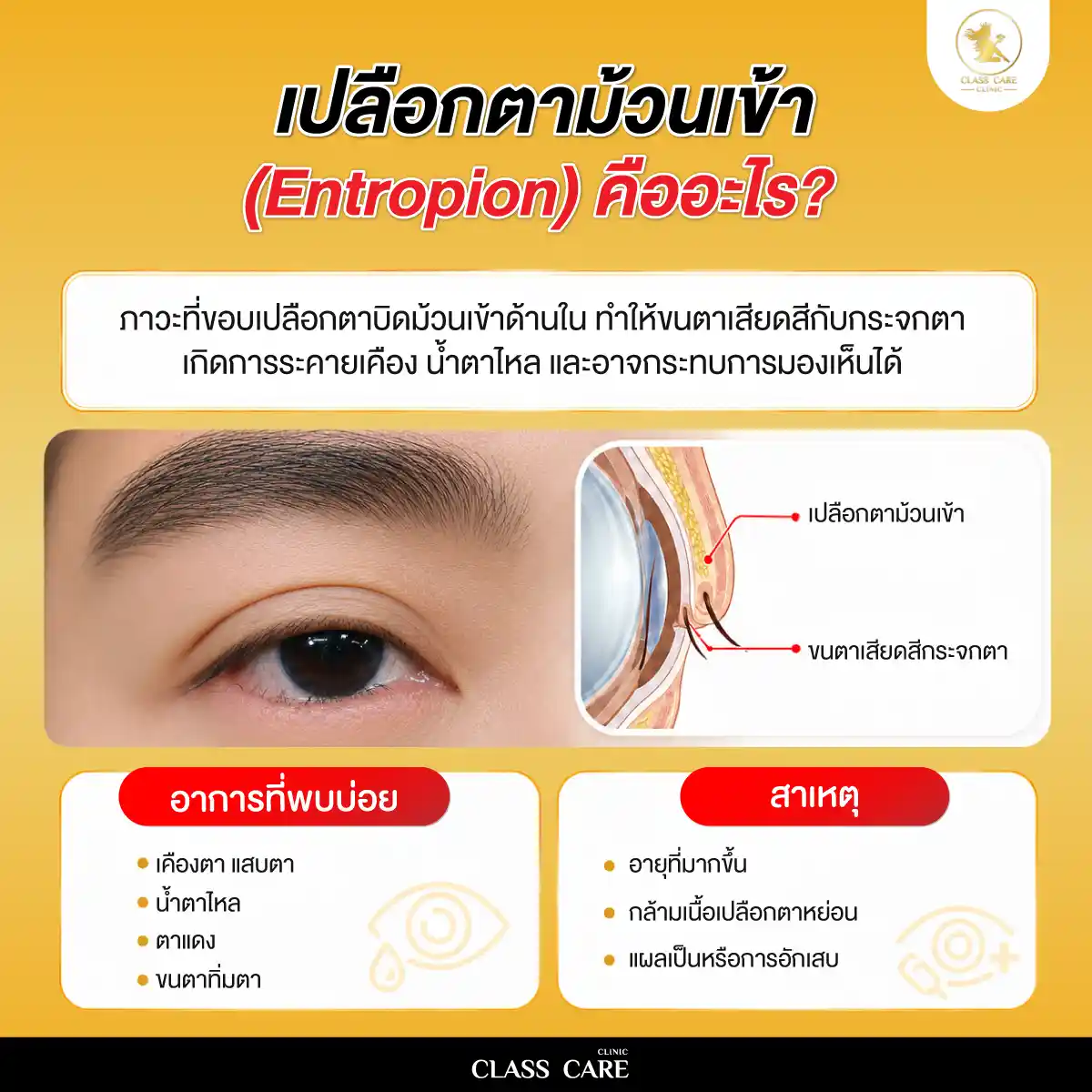เปลือกตาม้วนเข้า (Entropion) คืออะไร