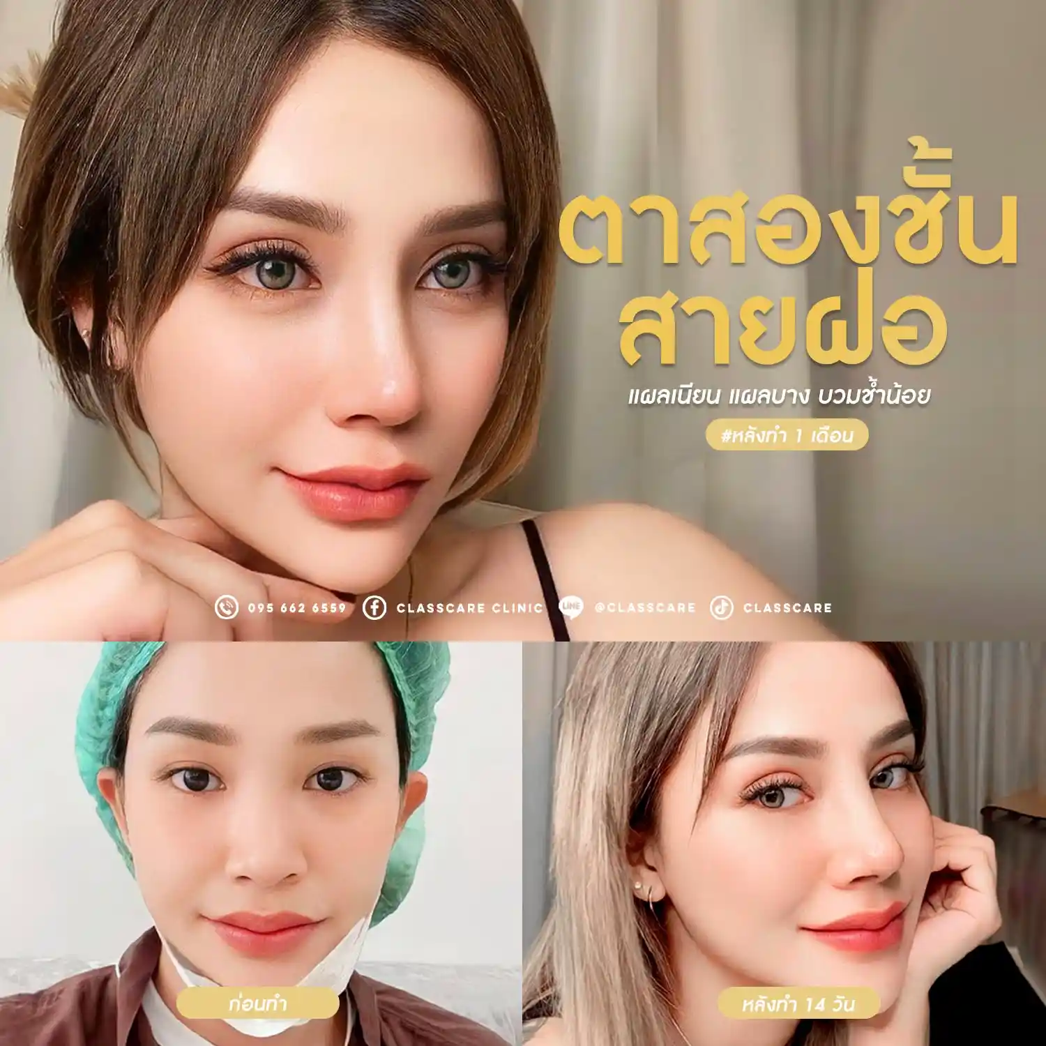รีวิวตาสองชั้น Classcare Clinic 01