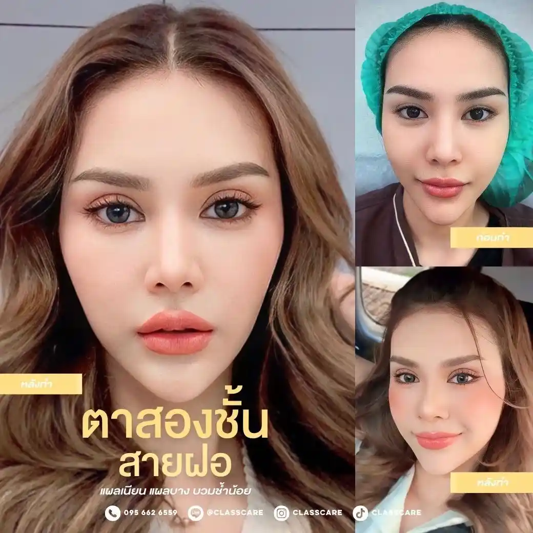 รีวิวตาสองชั้น Classcare Clinic 02