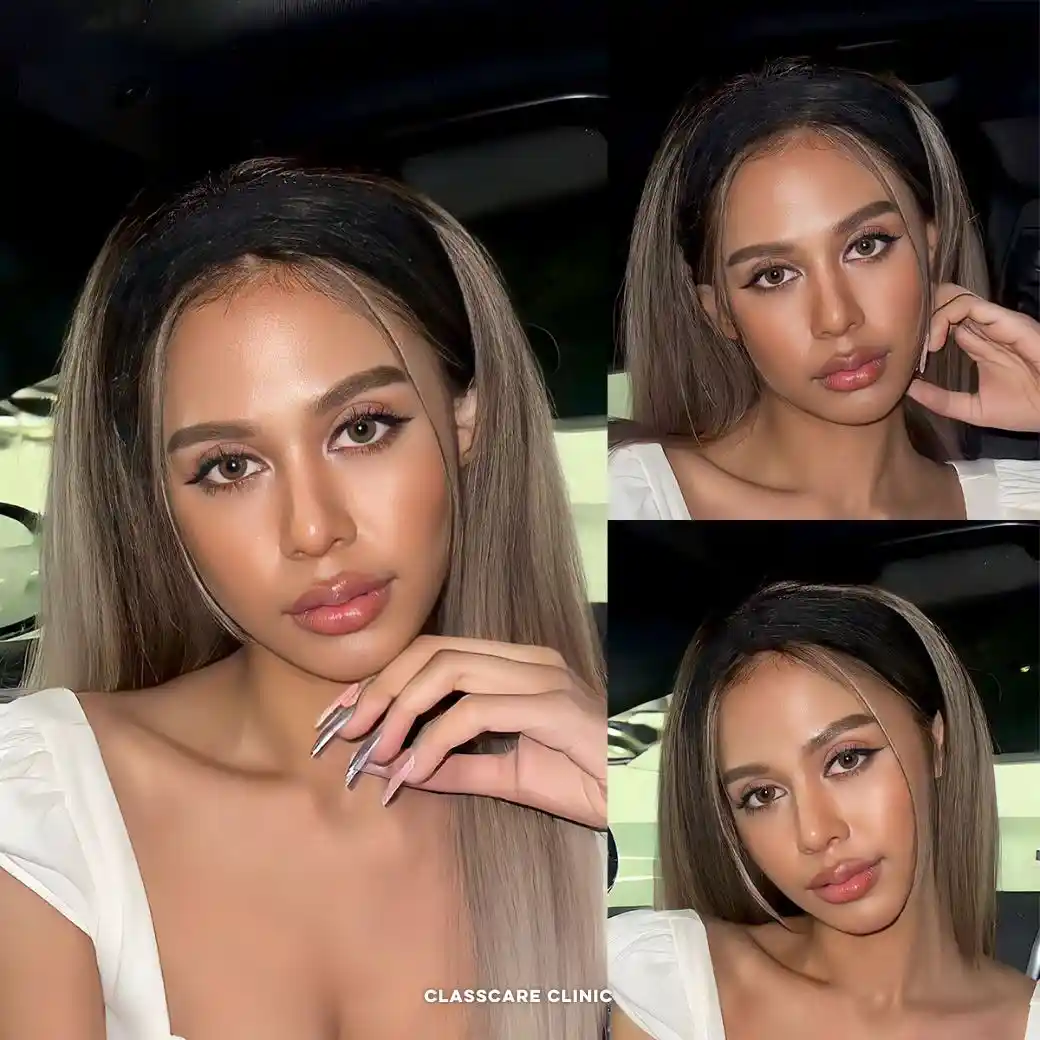 รีวิวตาสองชั้น Classcare Clinic 03