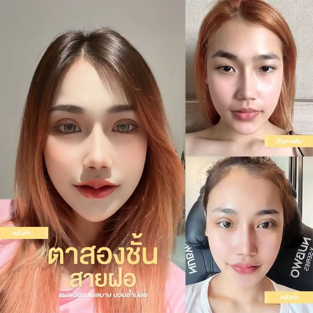 รีวิวตาสองชั้น Classcare Clinic 04