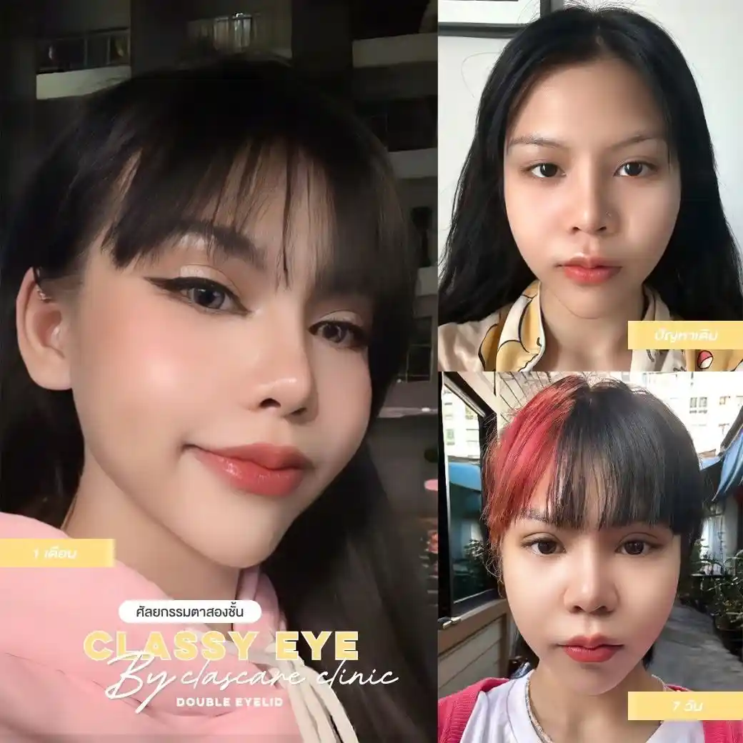 รีวิวตาสองชั้น Classcare Clinic 05