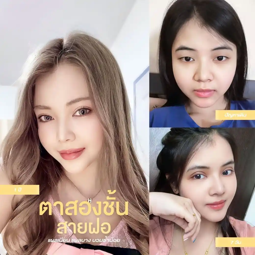 รีวิวตาสองชั้น Classcare Clinic 06
