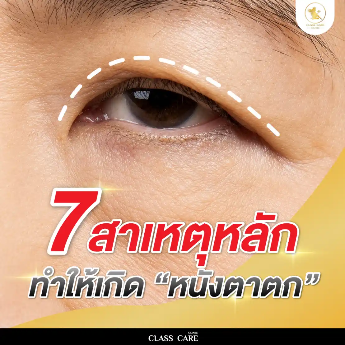 คนตาตกเกิดจากอะไร
