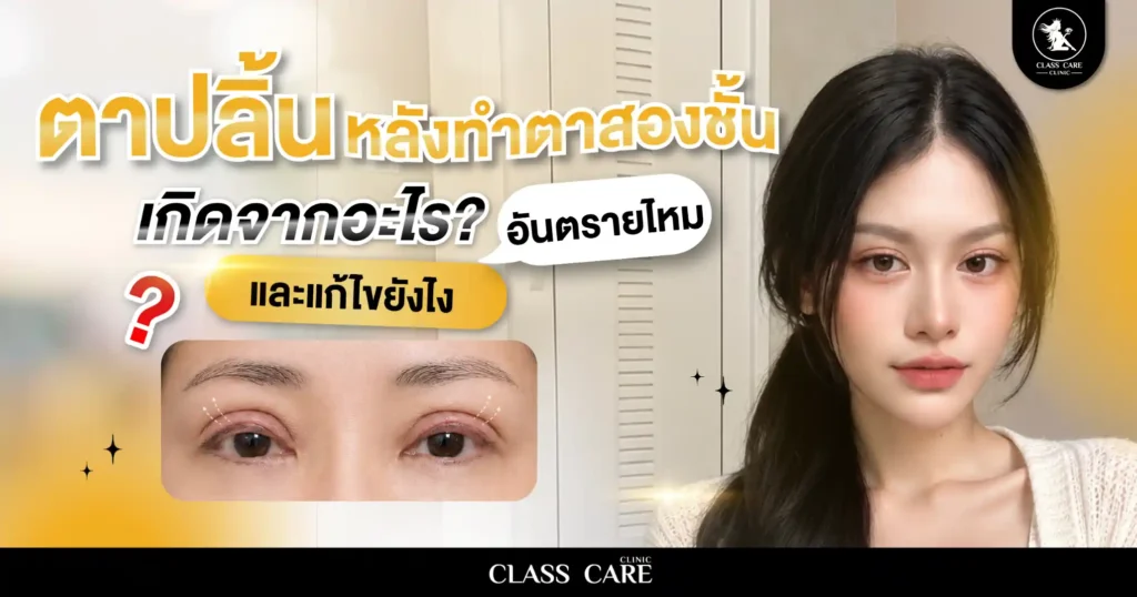 ตาปลิ้นหลังทำตาสองชั้น เกิดจากอะไร? อันตรายไหม และแก้ไขได้อย่างไร