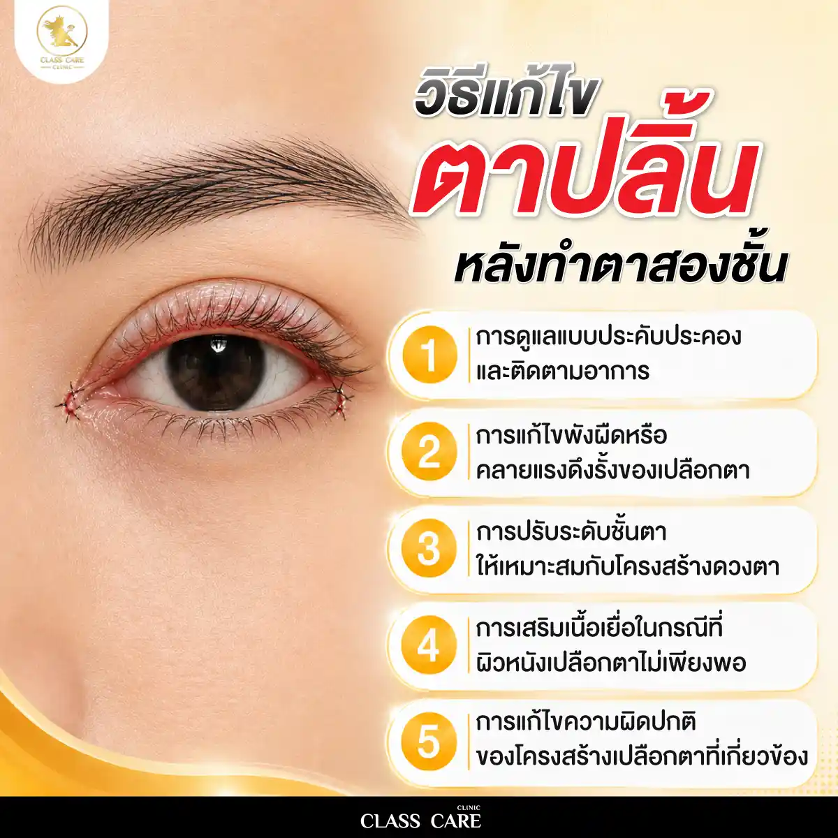 วิธีแก้ไขตาปลิ้นหลังทำตาสองชั้น