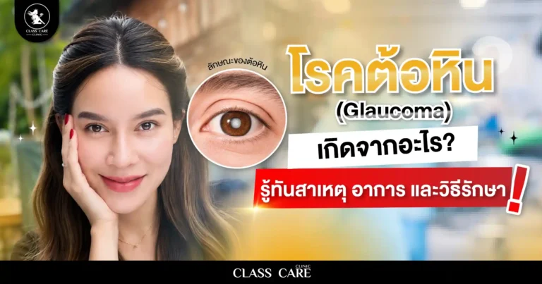 โรคต้อหิน (Glaucoma) เกิดจากอะไร? เช็กสาเหตุ อาการ และวิธีรักษา