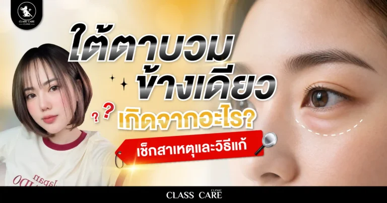 ใต้ตาบวมข้างเดียว เกิดจากอะไร? เช็กสาเหตุและวิธีแก้