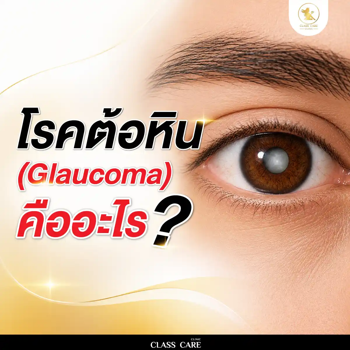 โรคต้อหิน (Glaucoma) คืออะไร