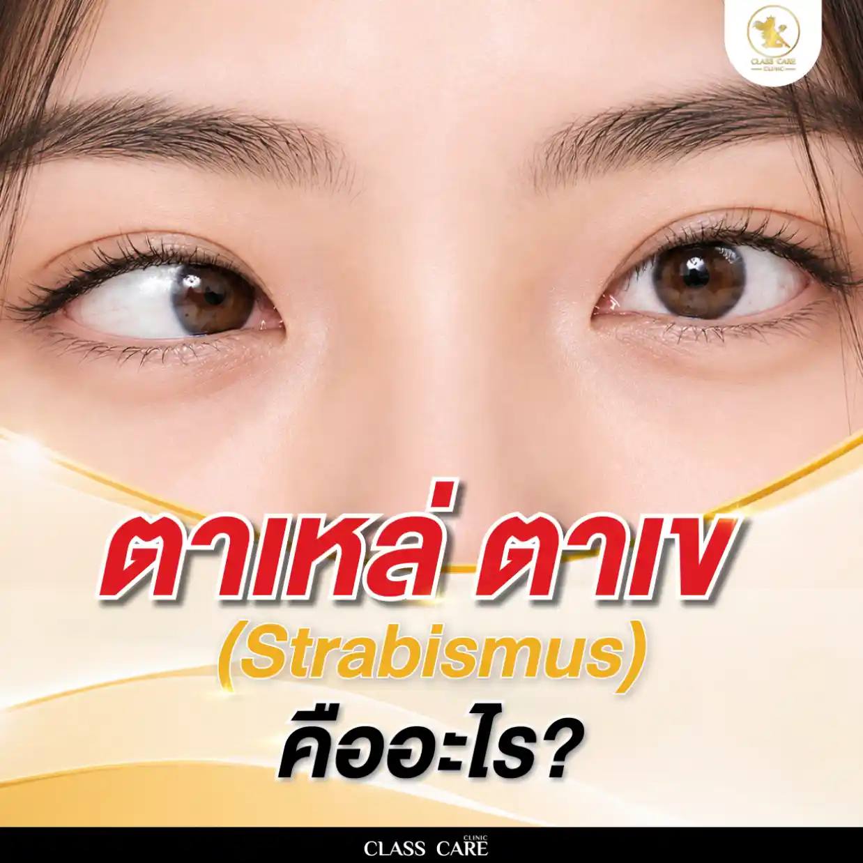 ตาเหล่ ตาเข (Strabismus) คืออะไร