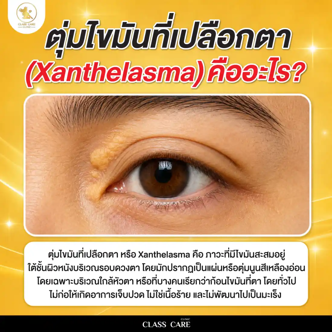 ตุ่มไขมันที่เปลือกตา (Xanthelasma) คืออะไร