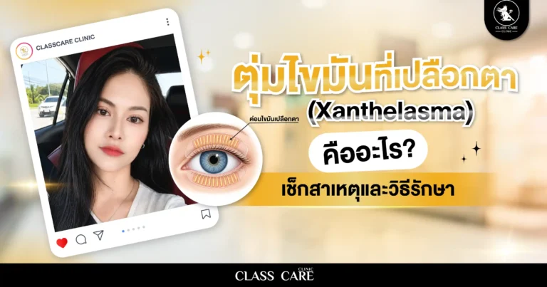 ตุ่มไขมันที่เปลือกตา (Xanthelasma) คืออะไร? เช็กสาเหตุและวิธีรักษา