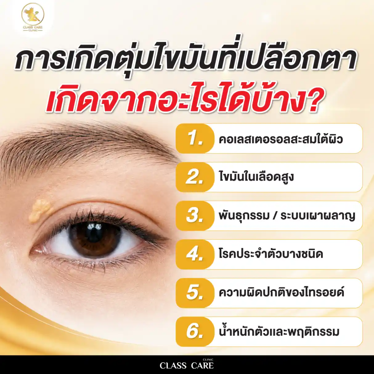 สาเหตุการเกิดตุ่มไขมันที่เปลือกตา